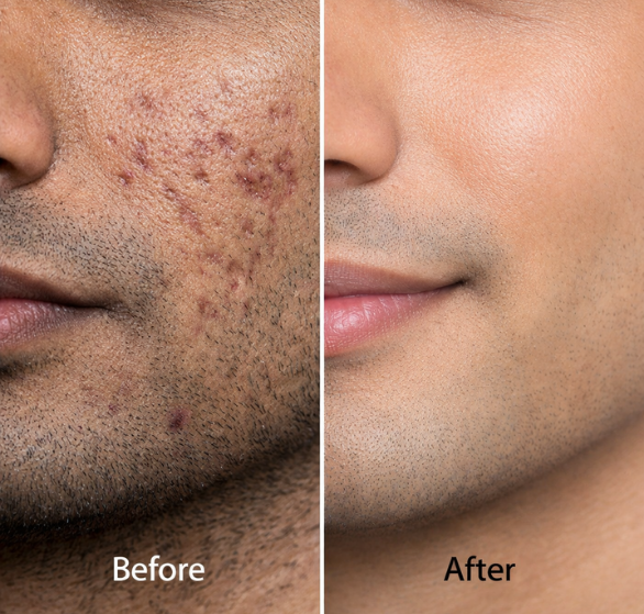 acne-scar-surgery